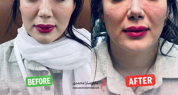 نمونه کار تزریق فیلر زیر چشم قبل و بعد